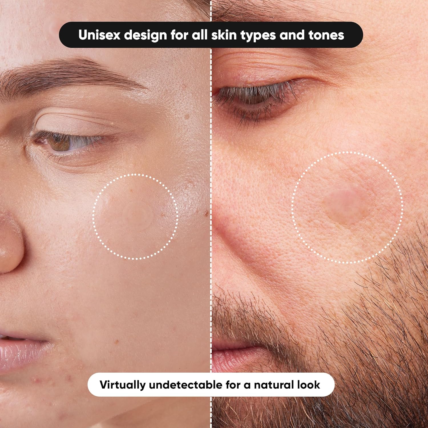 AliExpress Hydrocolloid Acne Patches, Alcohol-Free (40 or 400), view 5
