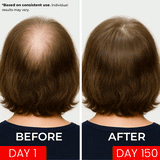APE BORN Red Light Therapy Hat - Regrow Hair Lost to Hormonal Imbalance, view 2