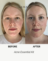 LAMAV Acne Essential Kit, view 3