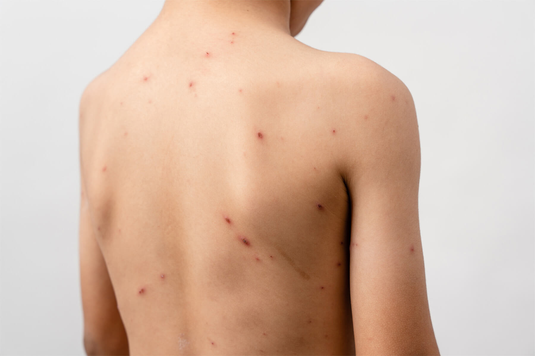 ZoomDoc Health Chickenpox recovery fit-to-fly certificate